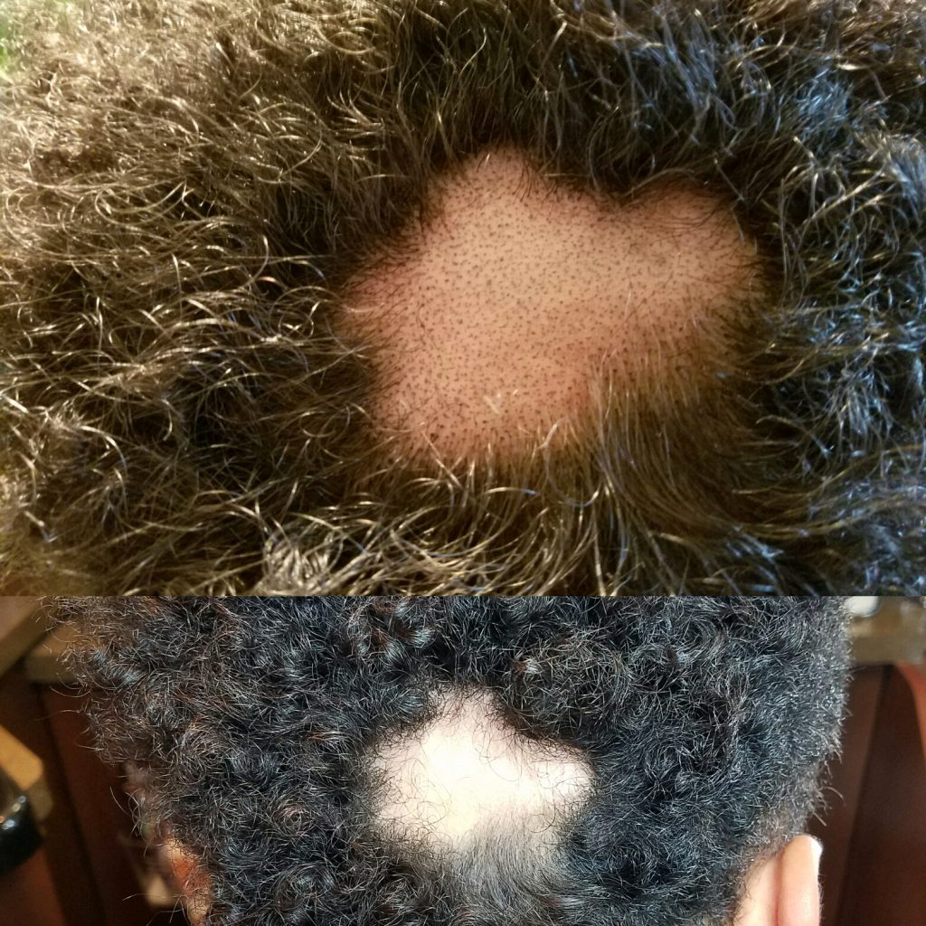 Scalp pigmentation by Transformations is life changing for both men and women