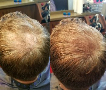 before and after image of mens hair replacement at Transformations Sylvania